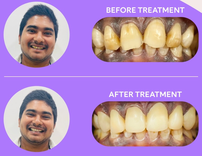 patient 5 - overbite with crossbite teeth before and after braces result