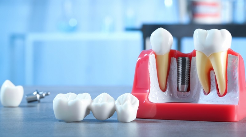 advantages benefits of dental bridges