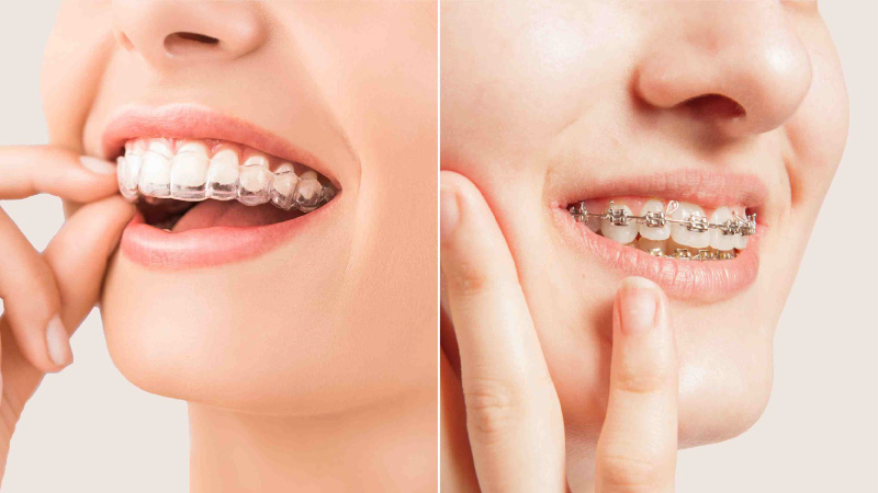 Braces vs. Aligners: Which Is Best for Your Perfect Smile?