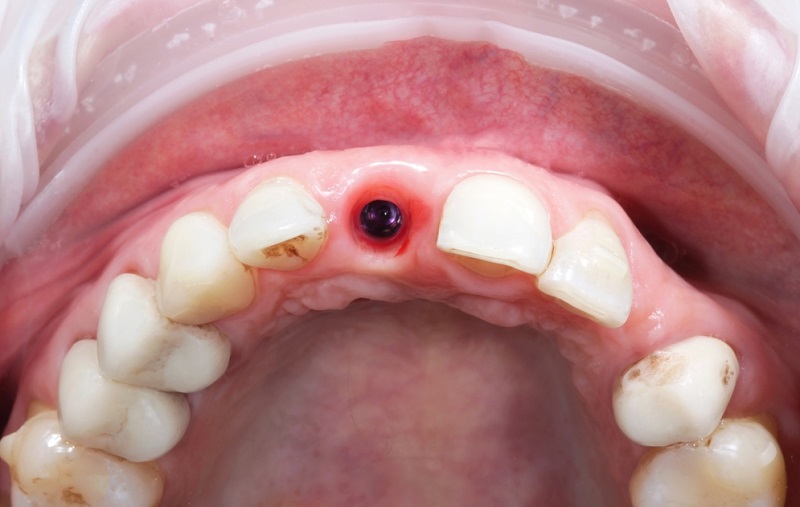 bad dental implants