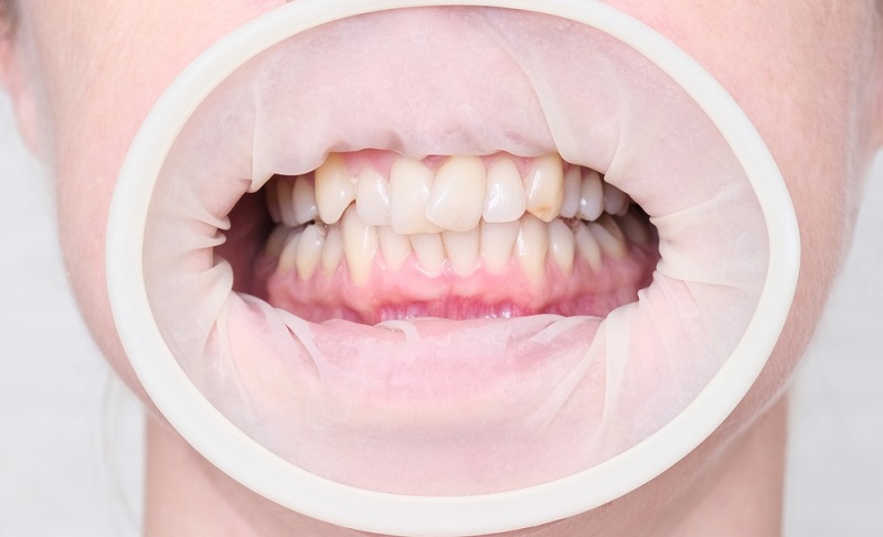 Align Your Smile, Elevate Your Career: Dealing with Bad Malocclusion in the Workplace