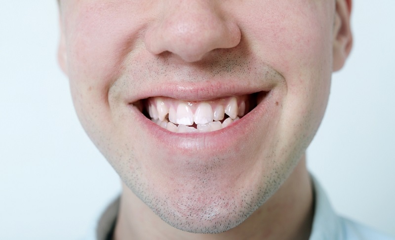 How Bite Problems Impact Your Overall Health at the Workplace?