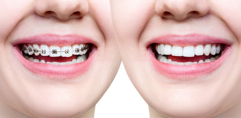 Dezy braces before and after treatment