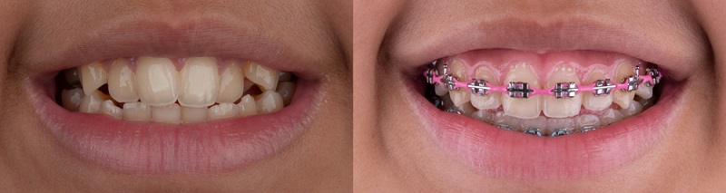 Dezy braces before and after treatment