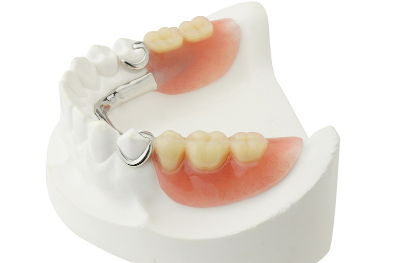 Cast Partial Denture: Your Key to a Confident Smile