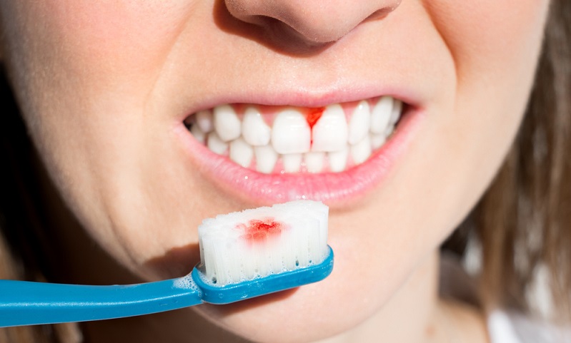 What Causes Bleeding Gums? Understanding the Factors and Solutions