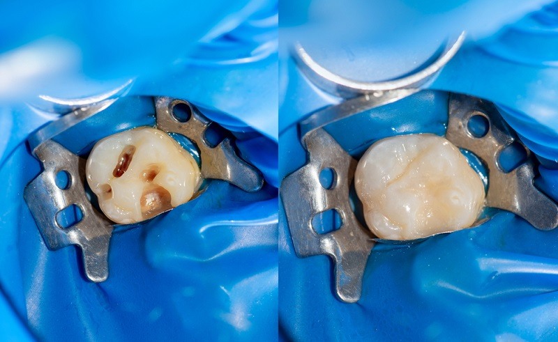 Cavity Filling: Procedure, Cost, and Do's and Don'ts