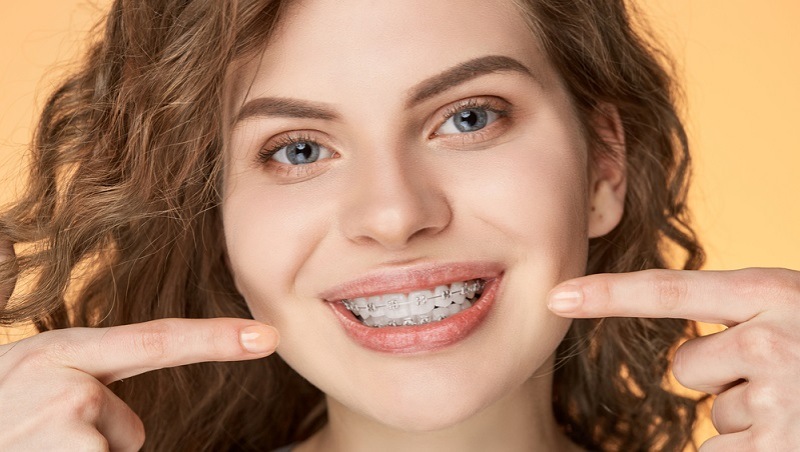Choosing Between Ceramic and Metal Braces: A Complete Guide