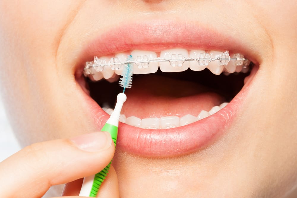 Ceramic Braces: Cost, Benefits, Maintenance & Care Tips