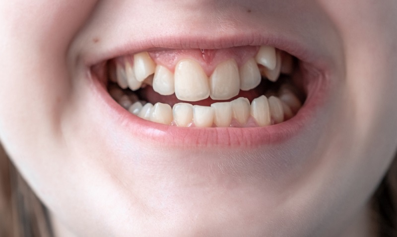 Class 2 Malocclusion: Causes, Treatments & Smile Transformations