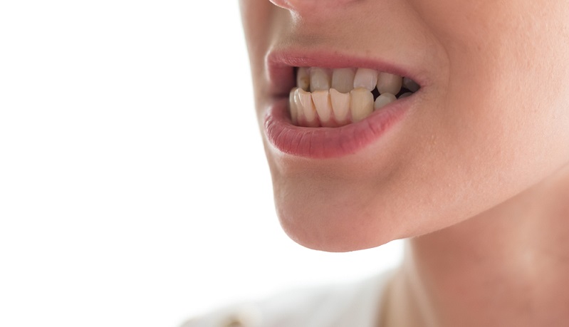 Class 3 Malocclusion: Causes, Treatments & Transformation