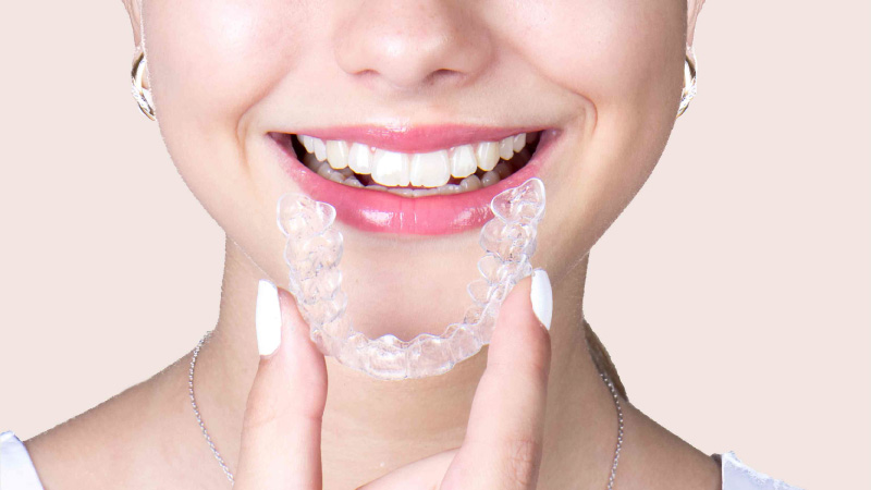 An Orthodontist Guide to Clear Aligners for Teeth Straightening