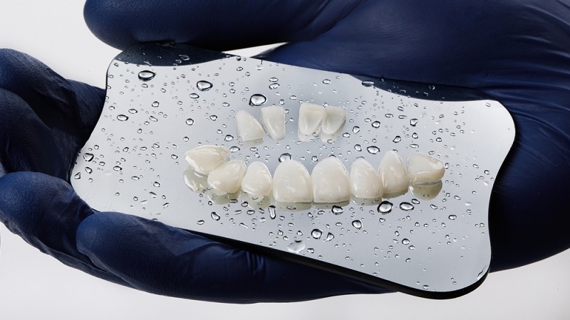 Composite Veneers: Procedure, Types, Cost, Pros and Cons