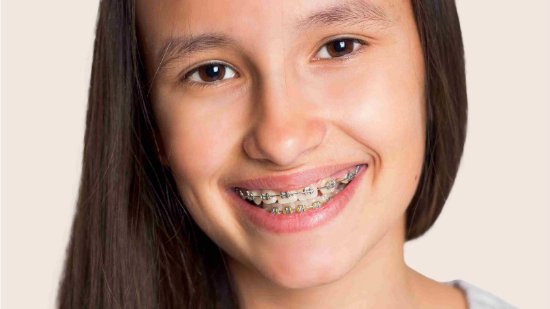 dental braces cost in india