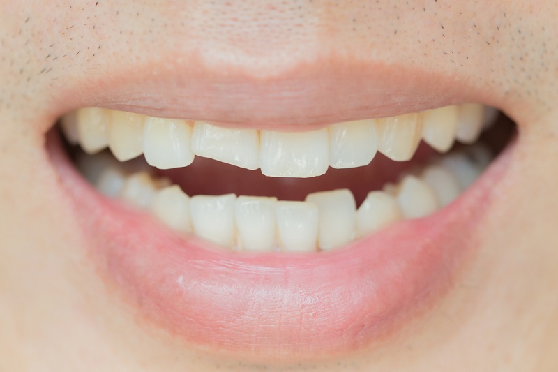 The Impact of a Cracked Tooth at the Workplace: Why Treatment is Crucial