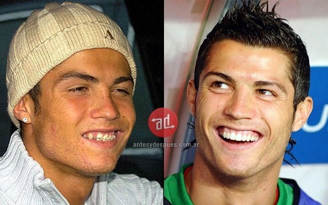 cristiano ronaldo dental implants