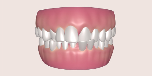 cross bite teeth