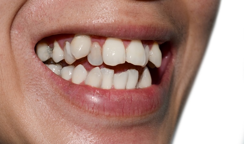 crowded teeth