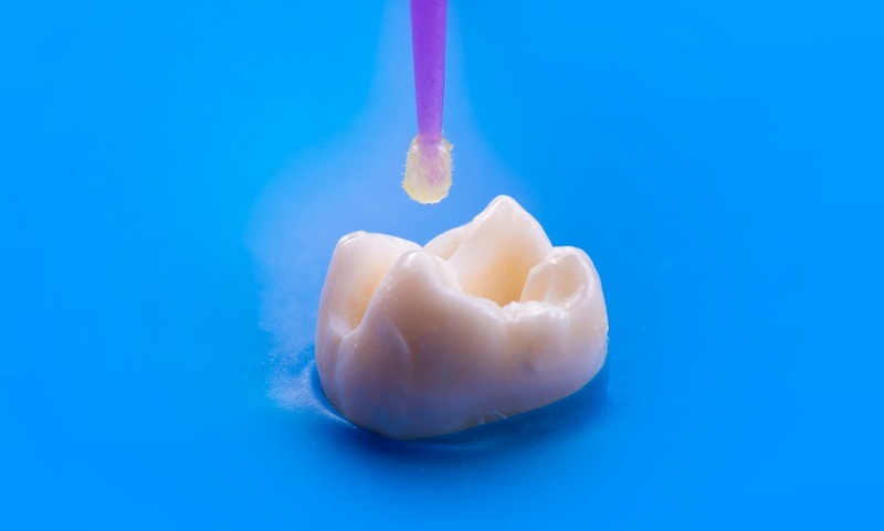How Much Does Dental Bonding Cost In India?