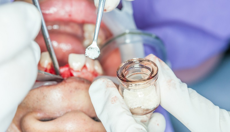 Dental Bone Graft: Process, Recovery & Costs You Should Know