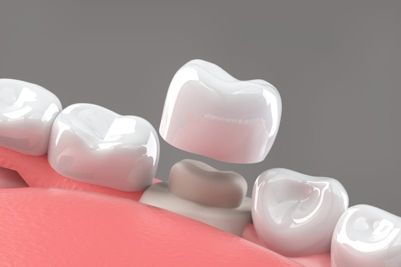 Dental Crowns in India: Types, Costs & Expert Insights