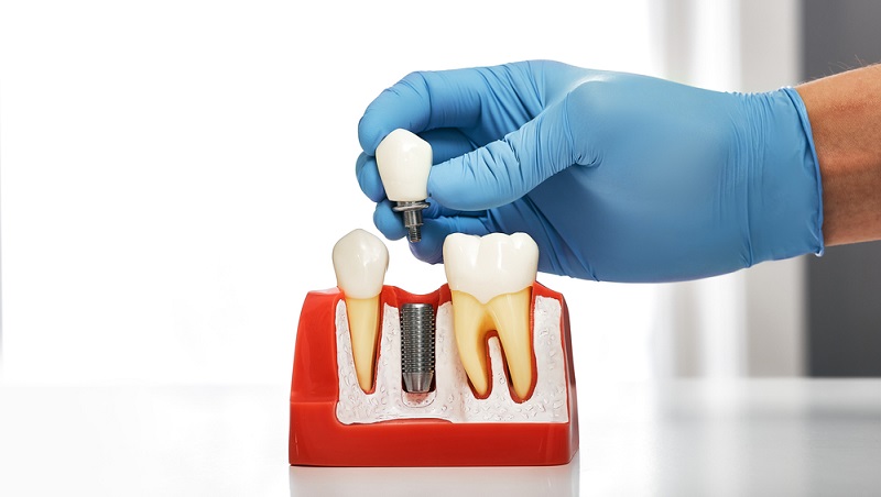 Making the Right Choice: What to Know About Dental Implants