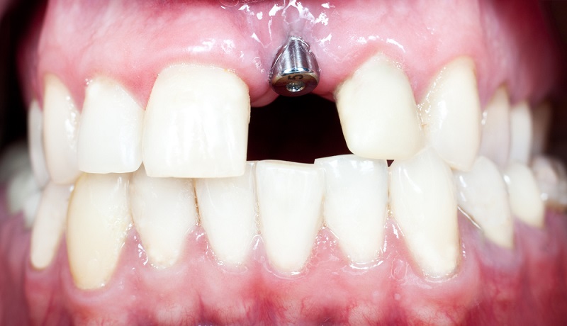 dental implants side effects risks and truth