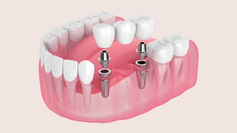 Essential Dos & Don’ts for a Smooth Dental Implant Recovery