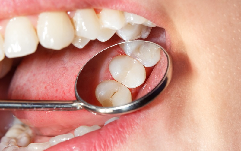 Everything You Need to Know About Dental Sealants