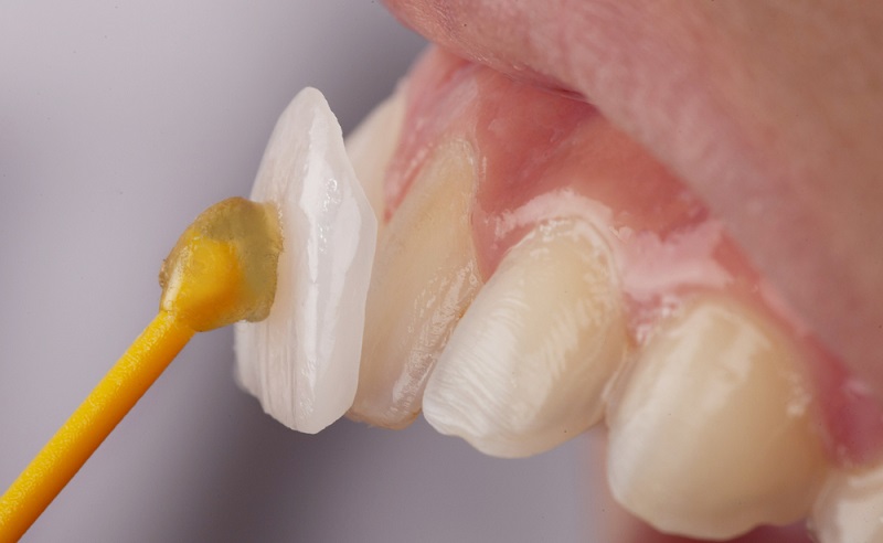 Veneers Teeth: What are They? Process, Benefits and Complications  