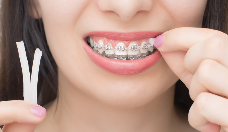 dental wax for braces