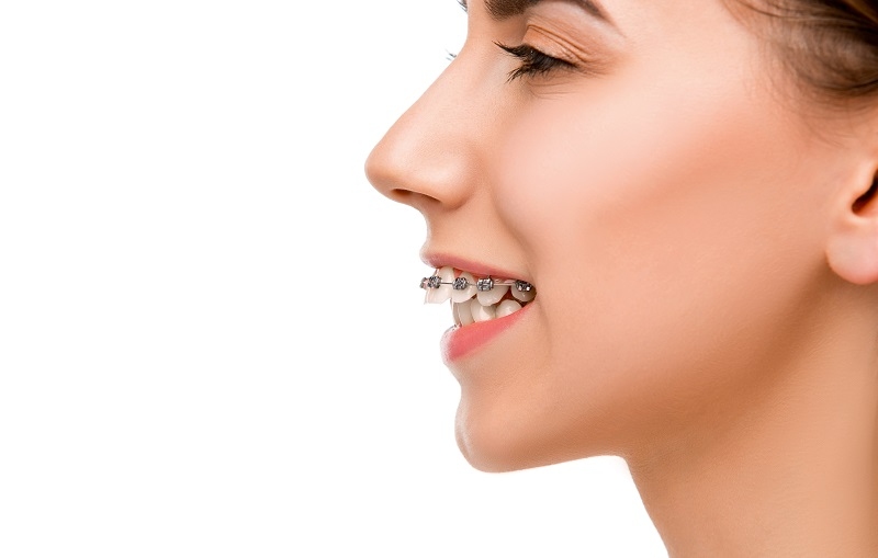 What are the Differences Between an Overjet and an Overbite?