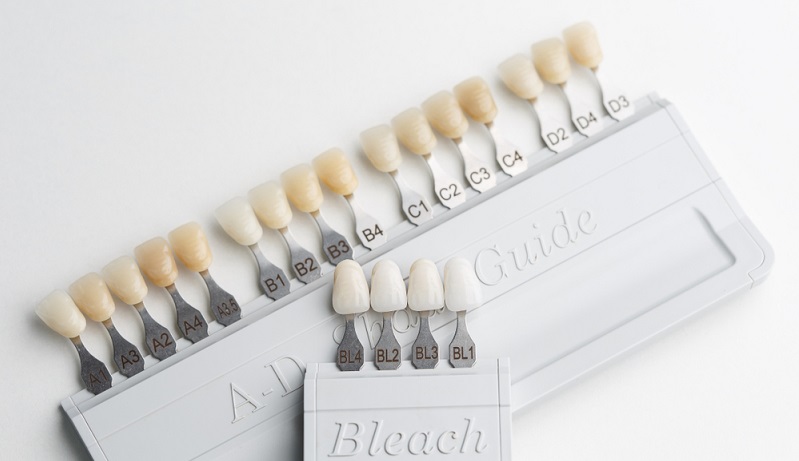 types of dental veneers