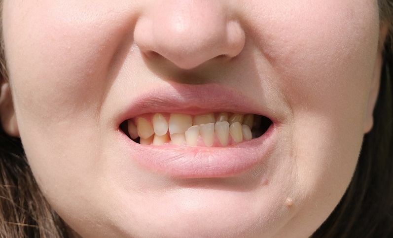 Dislocated Jaw: Symptoms, Diagnosis, Causes and Treatment