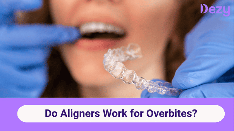 Do Aligners Work For Overbites?