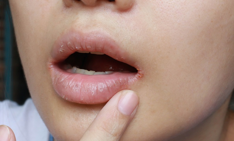 Dry Mouth: What are the Symptoms and What Causes It?