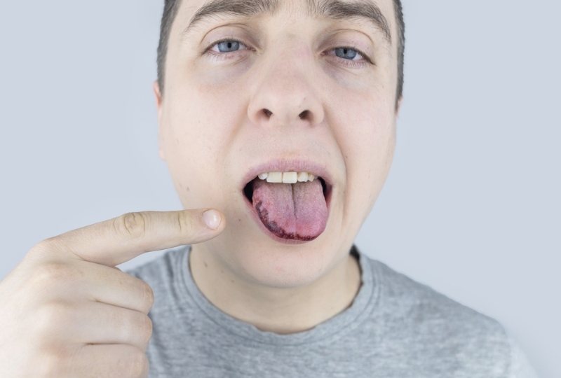 Dry Mouth Explained: Causes, Diagnosis & Effective Treatments