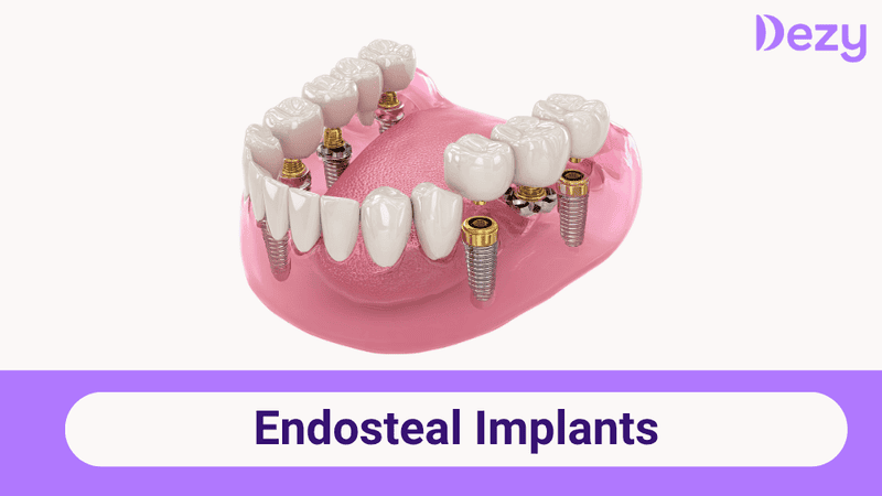 Endosteal Implants