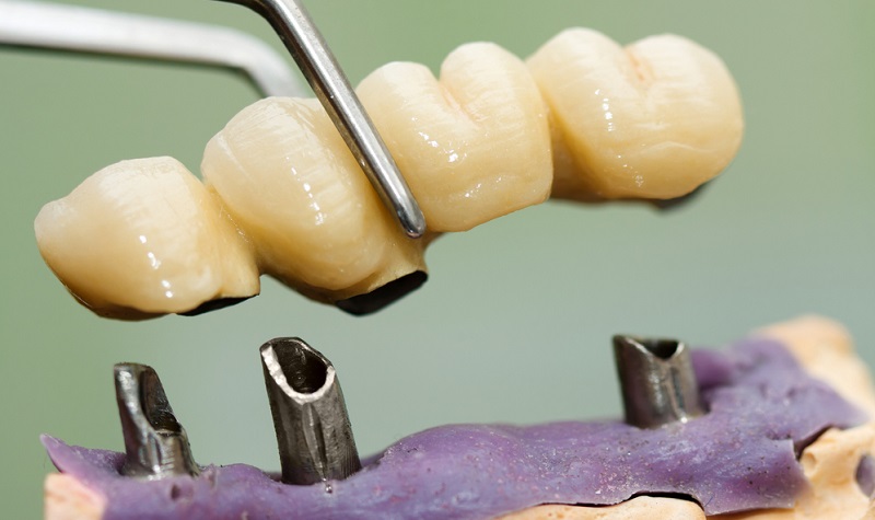 FPD fixed partial dentures procedure benefits cost aftercare