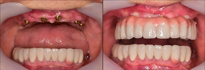 full complete dentures before after image