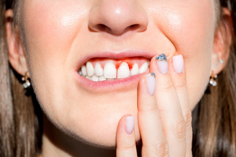 Gingivitis: Symptoms, Stages & How to Treat It Effectively