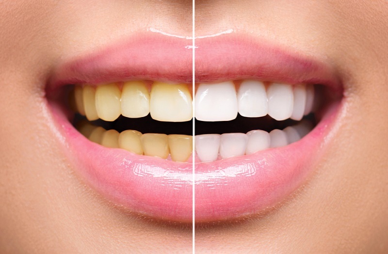 How to Clean Yellow Teeth at Home? Remedies to Clean Yellow Teeth