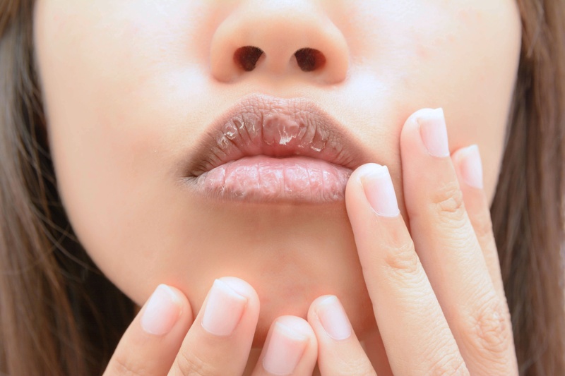Home Remedies To Miracle Cure Your Dry Mouth