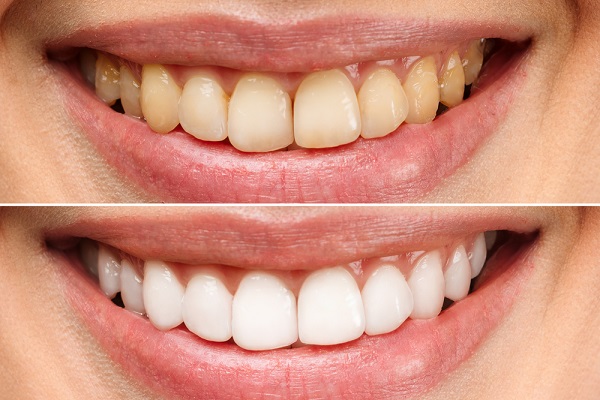 Hydrogen peroxide teeth whitening before and after Images 