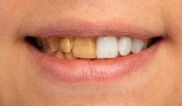 smokers teeth before and after Teeth whitening