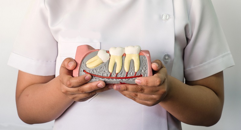 Impacted Wisdom Teeth: Symptoms, Risks & Treatment Options