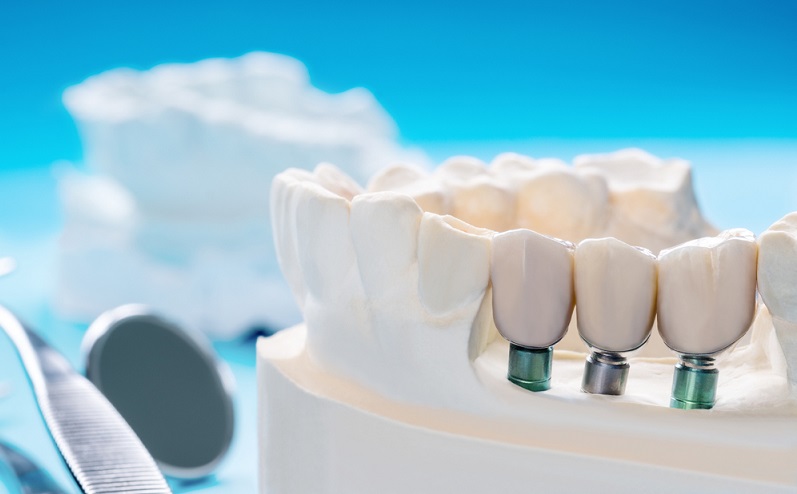 Implant Supported Dentures: Procedure, Benefits, Cost and Cleaning Tips