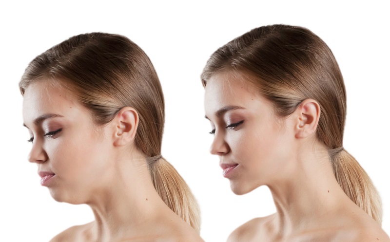 jaw surgery before and after