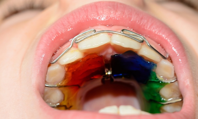 Lingual Retainers: Types, Benefits & How They Work