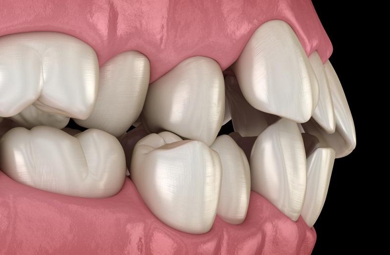 Malocclusion of Teeth: Definition, Classes, Types and Treatment